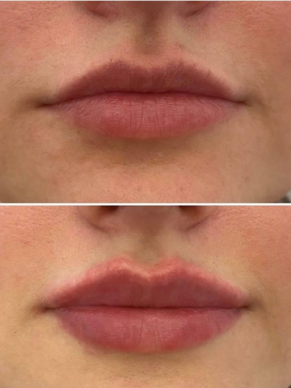 Контурная пластика губ