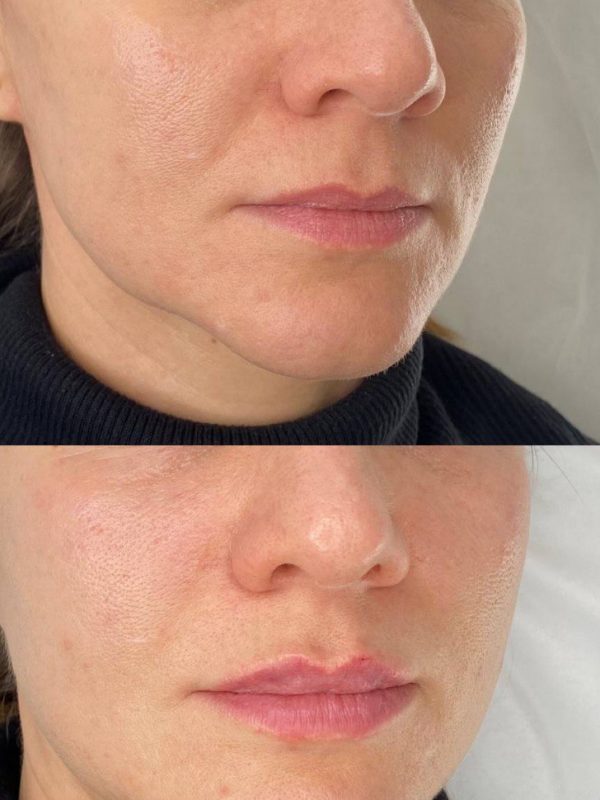 Увлажнение губ мягким филлером